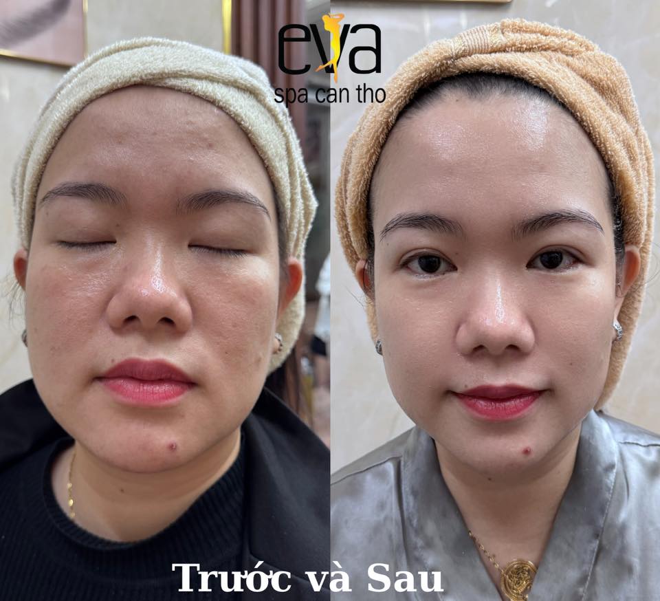 Trẻ Hóa Da Với Công Nghệ Hifu