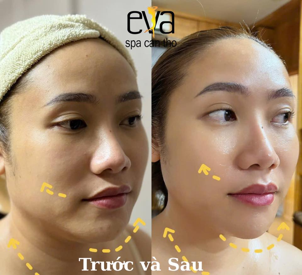 Trẻ Hóa Da Với Công Nghệ Hifu
