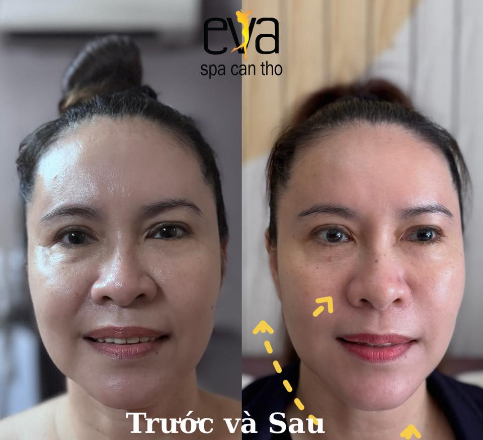 Trẻ Hóa Da Với Công Nghệ Hifu
