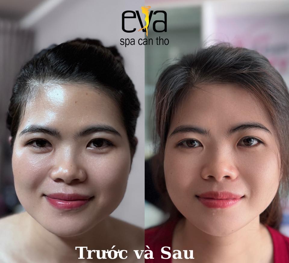 Trẻ Hóa Da Với Công Nghệ Hifu
