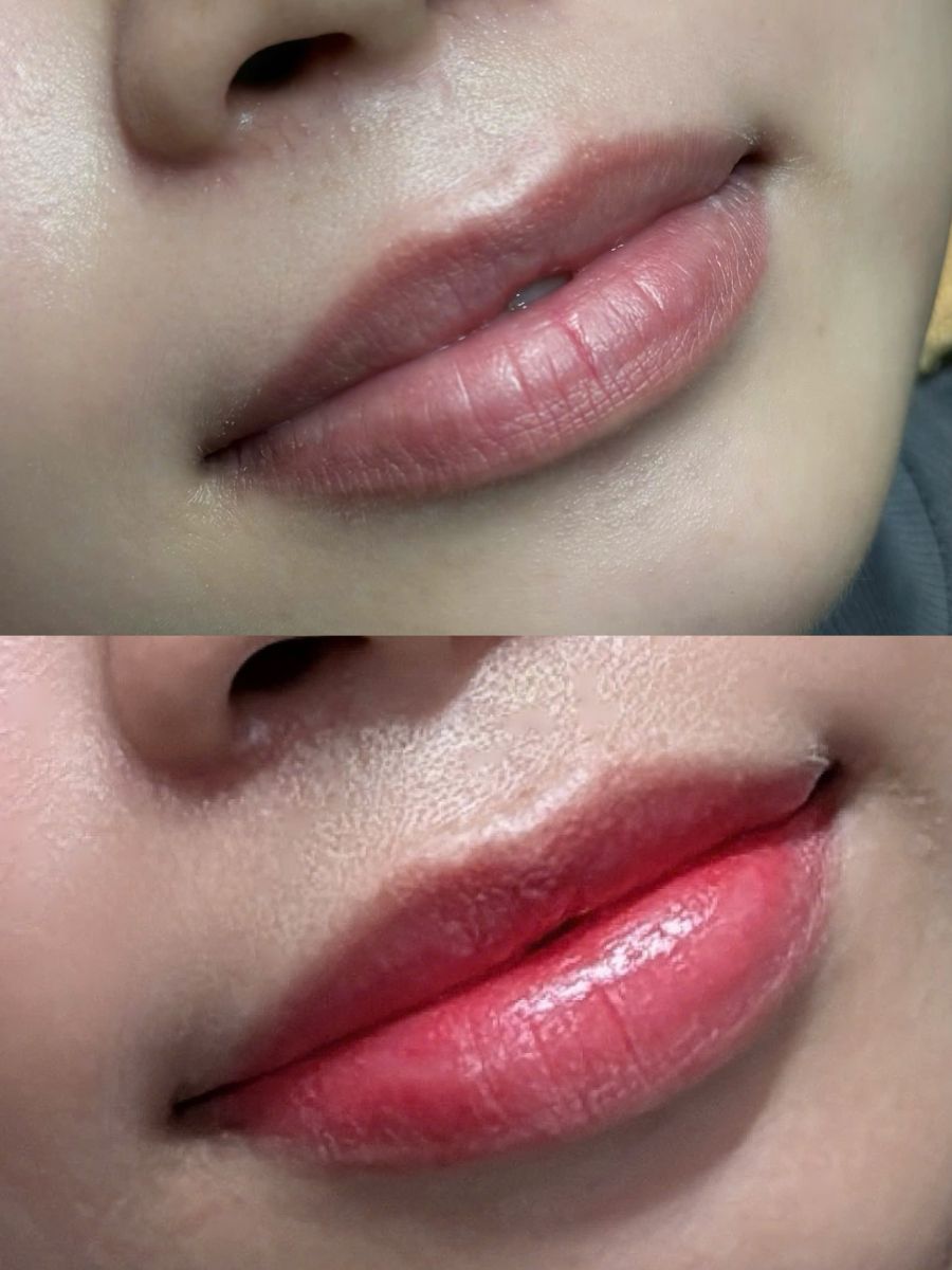 Combo xử lý thâm và phun môi Choushi