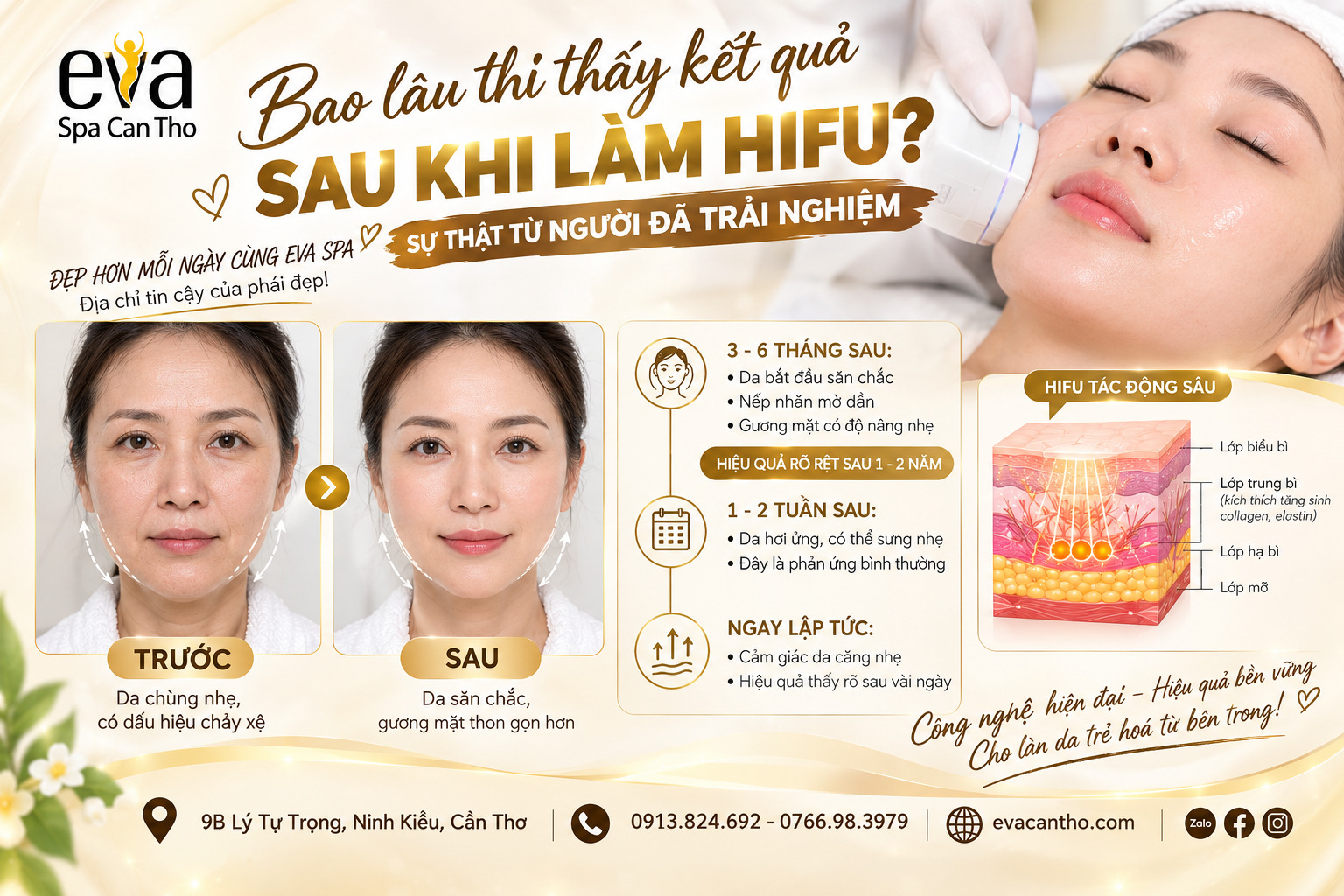 Bao lâu thì thấy kết quả sau khi làm HIFU?