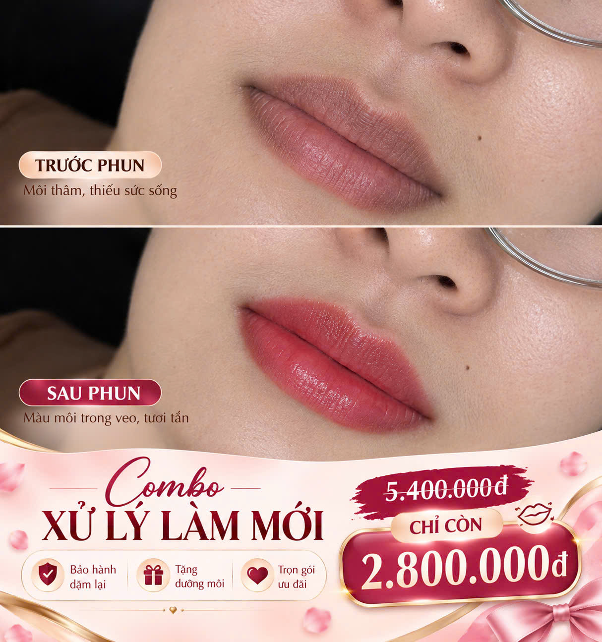 ƯU ĐÃI ĐỒNG GIÁ TRỌN COMBO XỬ LÝ LÀM MỚI MÔI